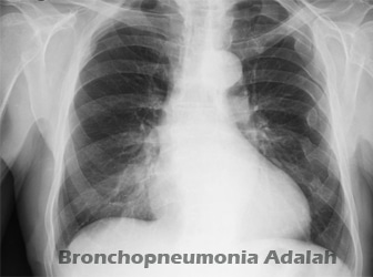 Bronchopneumonia-Adalah
