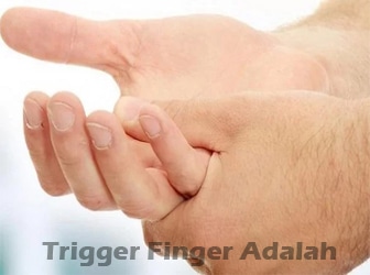 Trigger-Finger-Adalah