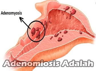 Adenomiosis-Adalah