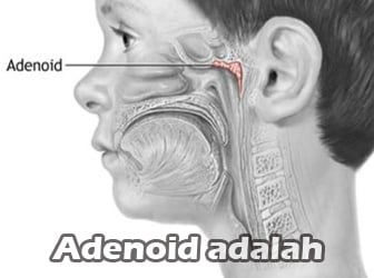 Adenoid-Adalah